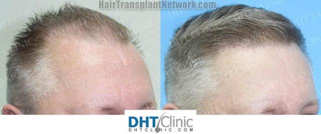 Hair restoration procedure after result images