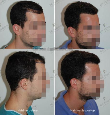 Hair transplantation procedure before and after results