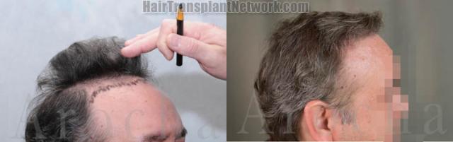 Hair restoration procedure before and after results