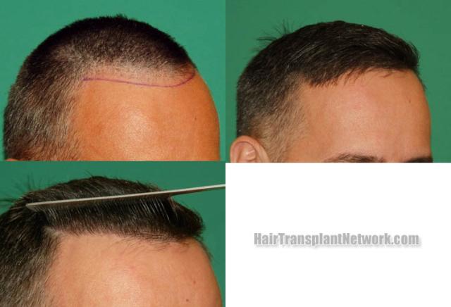 Hair restoration procedure before and after results