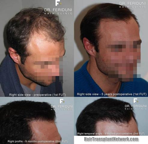 Hair transplantation surgery before and after images