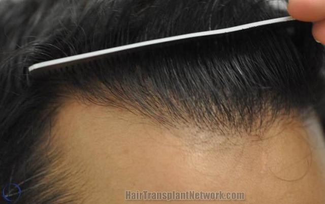 Hair transplant surgery before and after photos