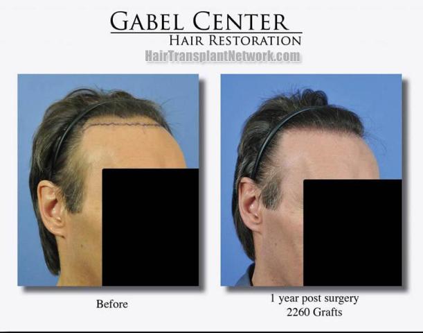 Hair transplantation surgery before and after pictures