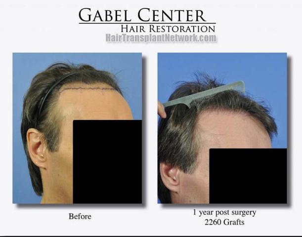 Hair transplant surgery before and after photos