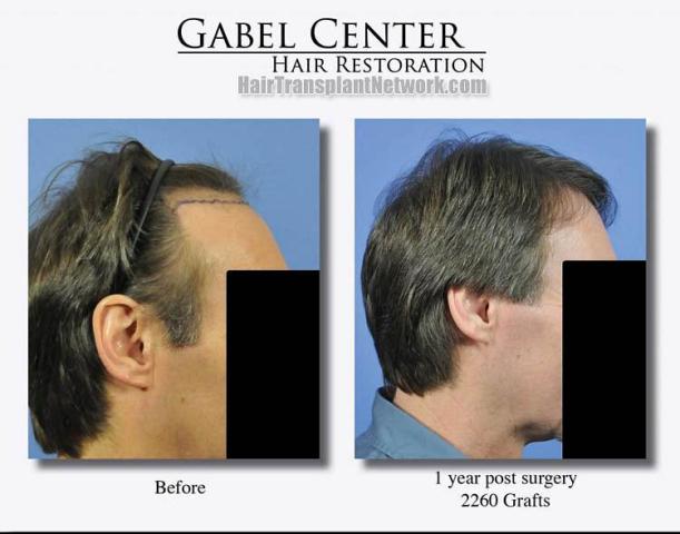 Hair transplantation surgery before and after photos