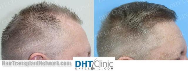 Hair restoration procedure before and after images