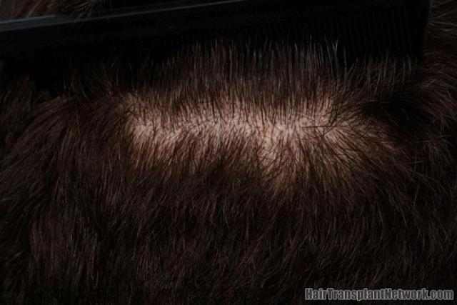 Residual scar photos from hair transplant patient donor area