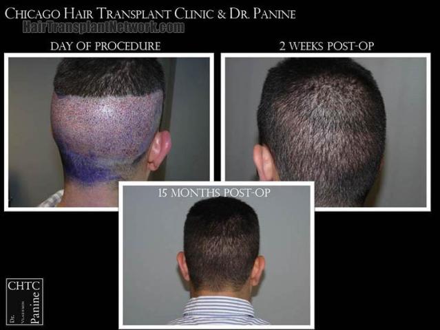 Hair transplantation surgery before and after pictures