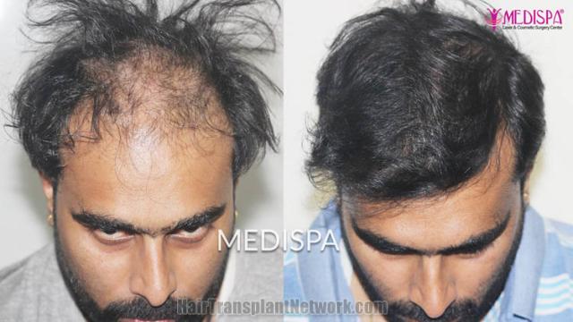 Hair restoration procedure before and after results