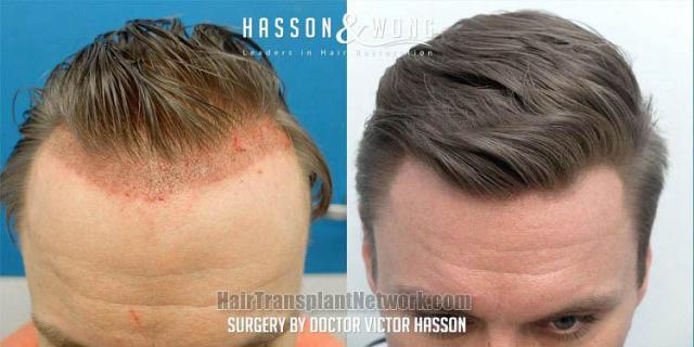 Top view - Before and after hair restoration procedure