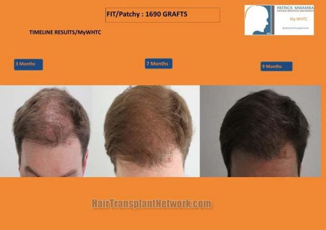 Hair transplantation surgery before and after photos