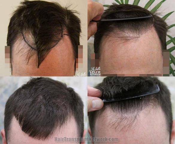 Before and after hair transplantation result photographs