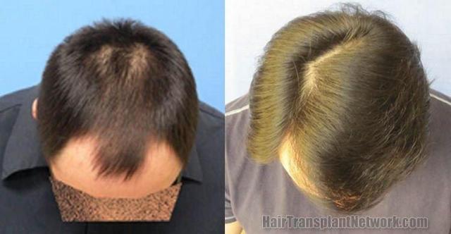 Top view showing hair transplant results from 4298 grafts