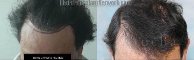 Top view hair restoration procedure repair to correct plugs