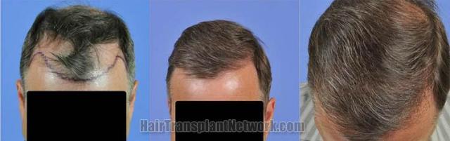 Hair restoration procedure results