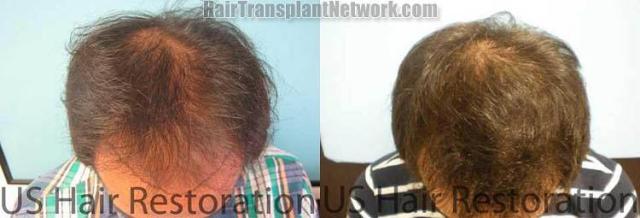 Top view before and after hair restoration results