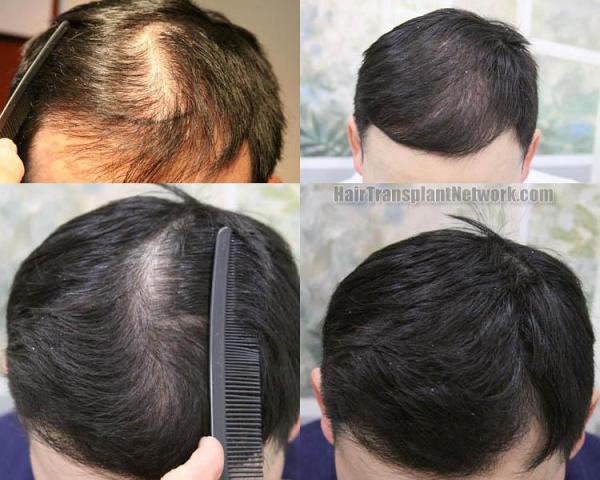 Before and after hair transplant procedure images