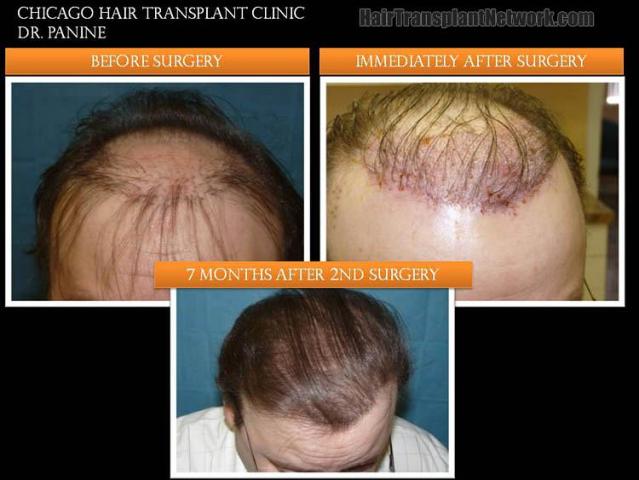 Top view before and after hair restoration results