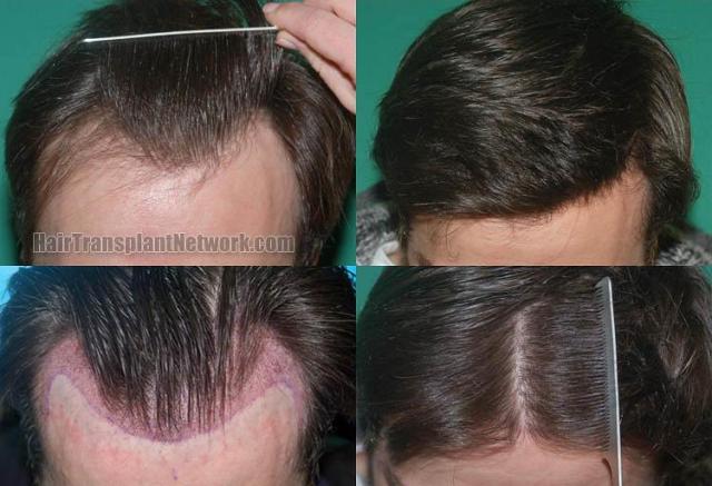 Top view before and after hair restoration results