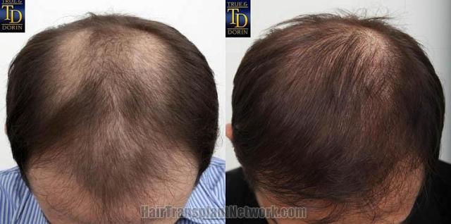 Before and after hair transplantation result photographs