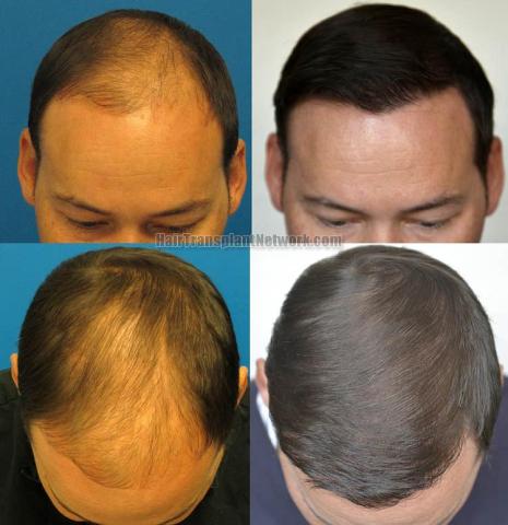 Hair transplantation surgery before and after photos