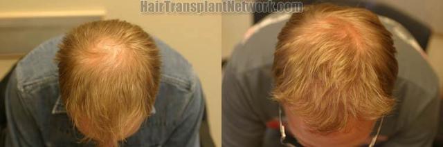 Top view before and after hair restoration results