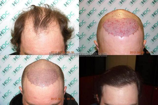 Hair restoration procedure before and after results