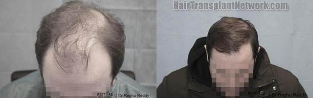 Top view before and after hair restoration results