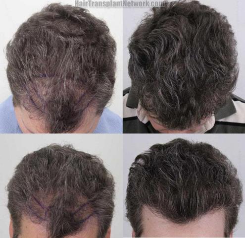 Hair transplantation surgery before and after photos