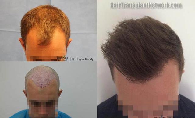 Hair transplantation surgery before and after pictures