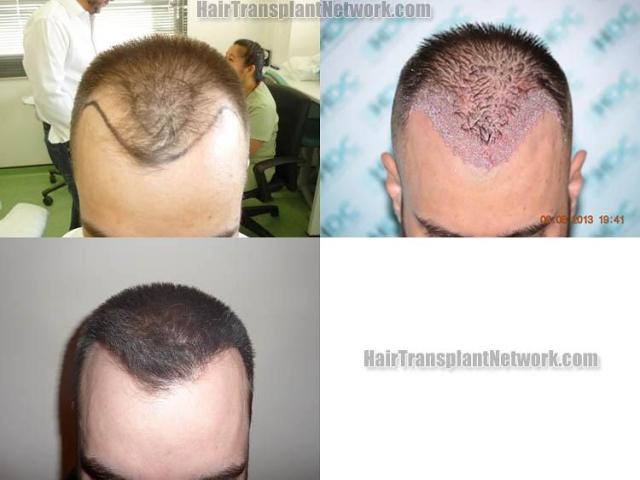 Hair transplantation surgery before and after photos