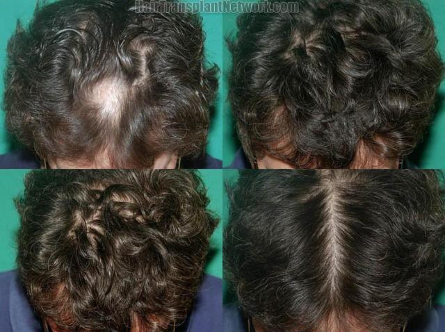 Hair transplantation surgery before and after photos