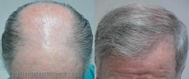 Hair transplantation surgery before and after photos