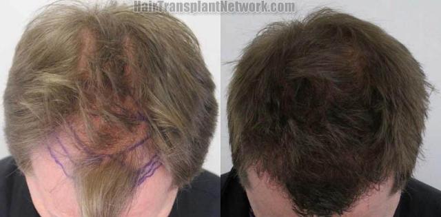 Hair restoration procedure before and after pictures