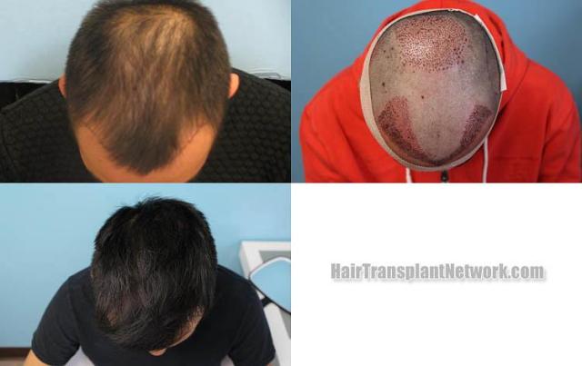 Top view before and after hair restoration results