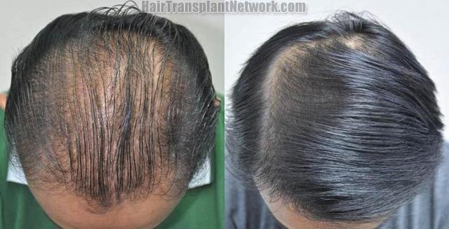 Hair transplantation surgery before and after photos