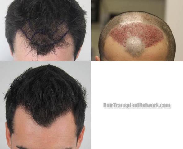 Top view before and after hair restoration results