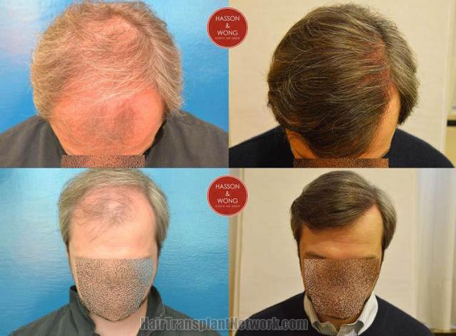 Hair restoration procedure before and after pictures