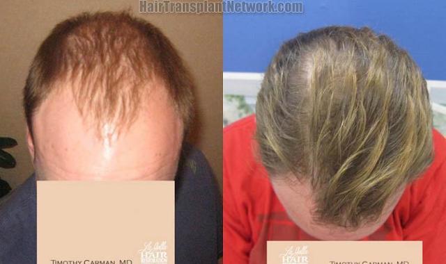 Hair restoration procedure before and after results