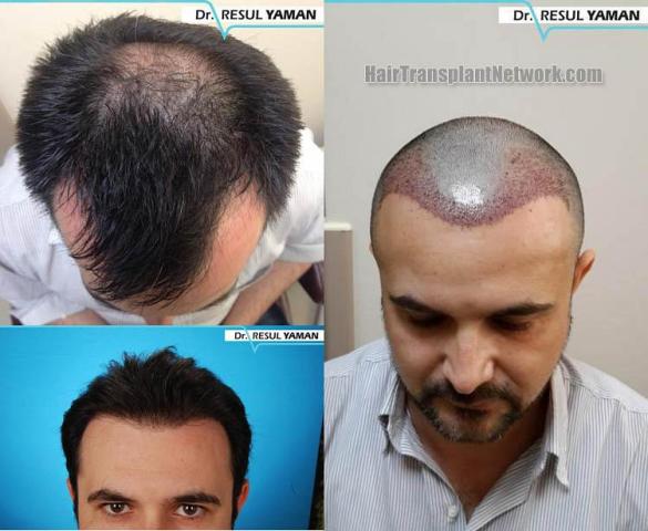 Top view - Before and after surgical hair replacement