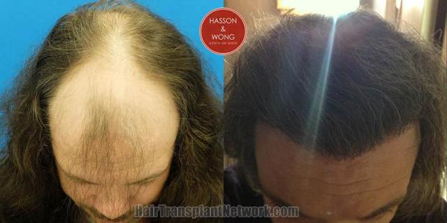 Hair transplantation surgery before and after photos