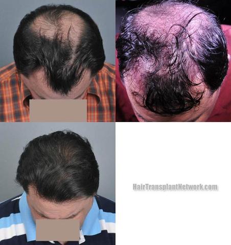 Surgical hair transplantation result photographs