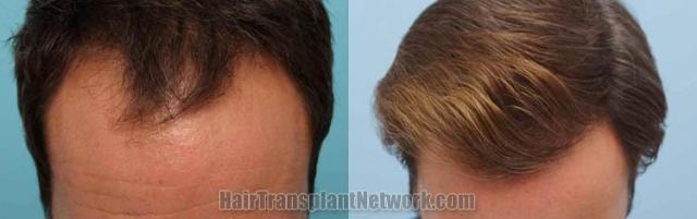 Hair transplantation surgery before and after photos