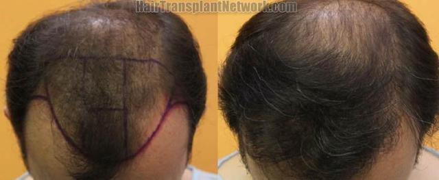 Hair transplantation surgery before and after pictures