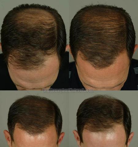 Hair transplantation surgery before and after pictures