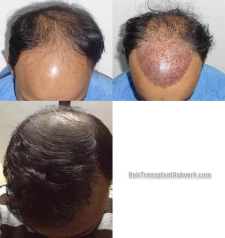 Hair transplantation surgery before and after photos