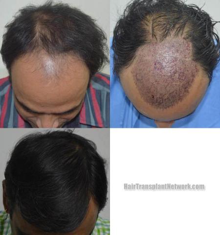 Hair restoration procedure before and after results