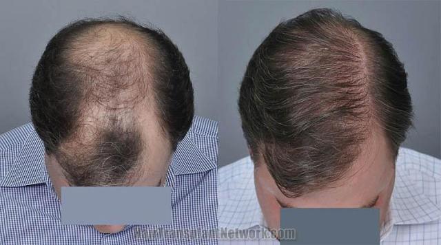 Hair restoration procedure before and after results