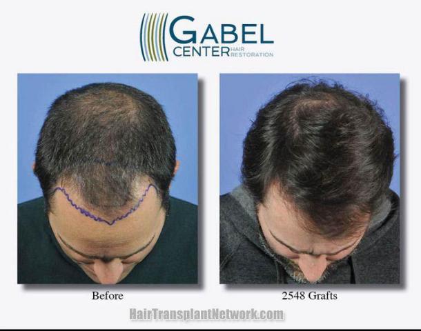 Hair restoration procedure before and after results