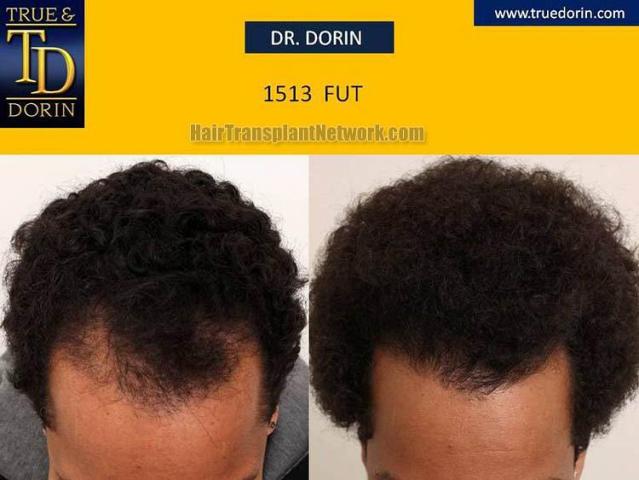 Hair transplantation surgery before and after pictures